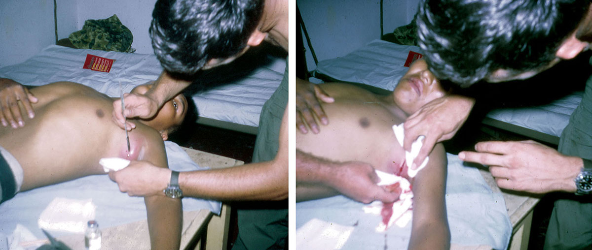 SSG James Hapka treats a Bolivian soldier with a glandular infection in his armpit.